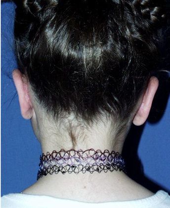 Otoplasty*: Case 1 - Back After