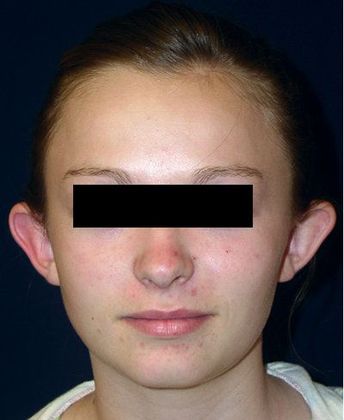 Otoplasty*: Case 2 - Front Before