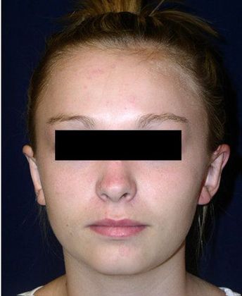 Otoplasty*: Case 2 - Front After