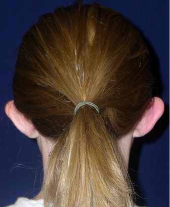 Otoplasty*: Case 2 - Back Before