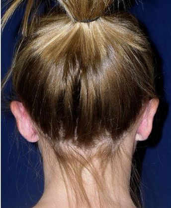 Otoplasty*: Case 2 - Back After