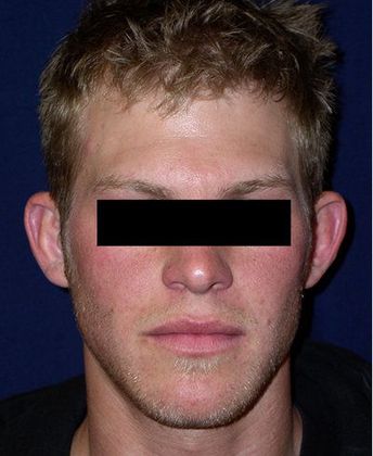 Otoplasty*: Case 3 - Front Before