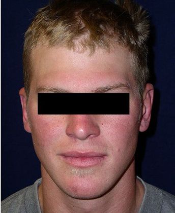 Otoplasty*: Case 3 - Front After