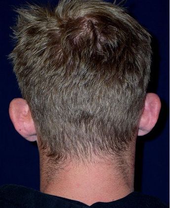 Otoplasty*: Case 3 - Back Before