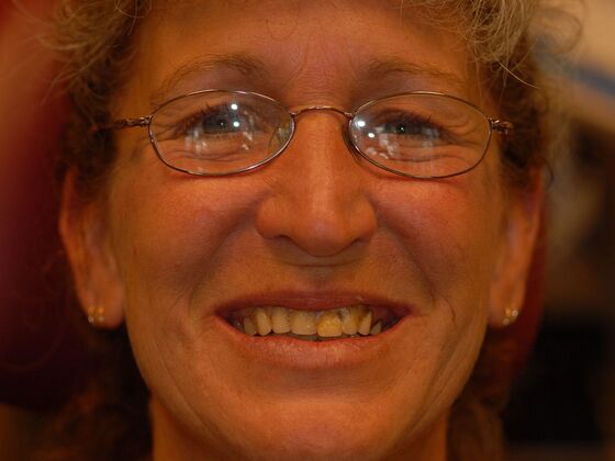 Dentures: Case 1 - Before