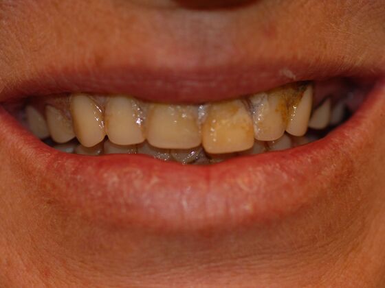 Dentures Case 1 - Before