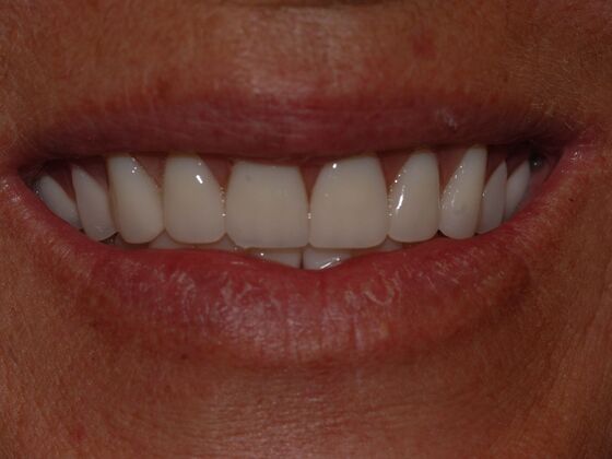 Dentures Case 1 - After