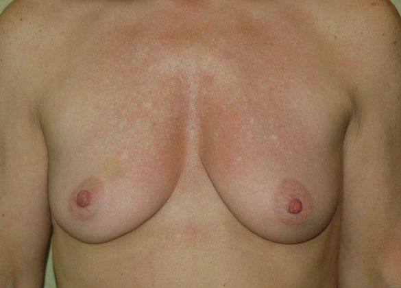 Breast Augmentation w/ Lift: Case 92 - Before