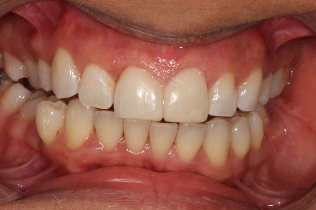 Eating after teeth whitening
