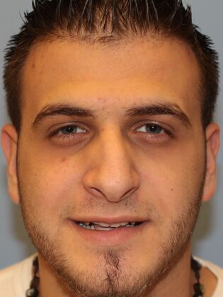 Rhinoplasty: Case 5 - Before