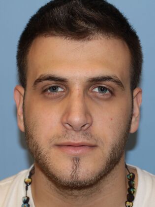 Rhinoplasty: Case 5 - After