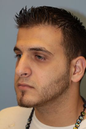 Rhinoplasty: Case 5 - Before