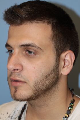 Rhinoplasty: Case 5 - After