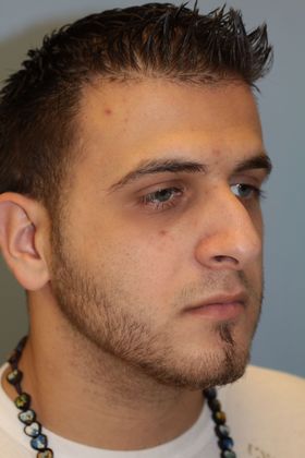 Rhinoplasty: Case 5 - Before