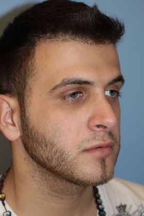 Rhinoplasty: Case 5 - After