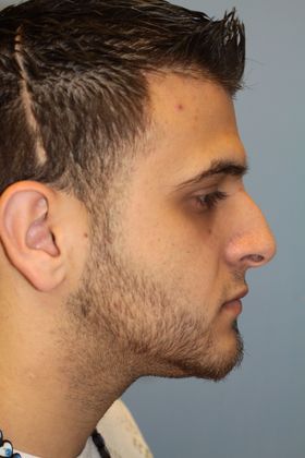 Rhinoplasty: Case 5 - Before