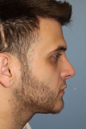 Rhinoplasty: Case 5 - After