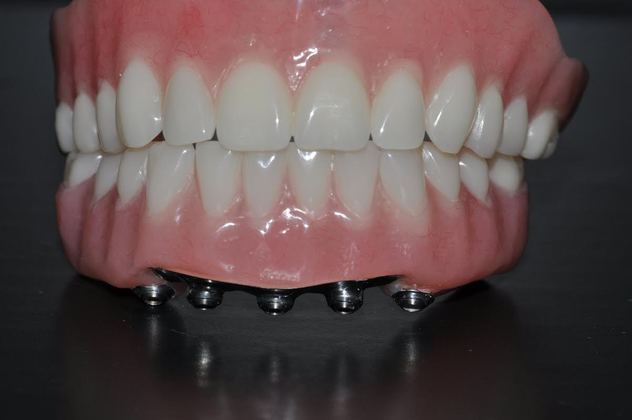 Full Mouth Restoration: Full Mouth Restoration