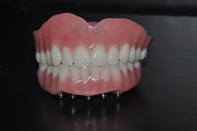 Full Mouth Restoration: Full Mouth Restoration