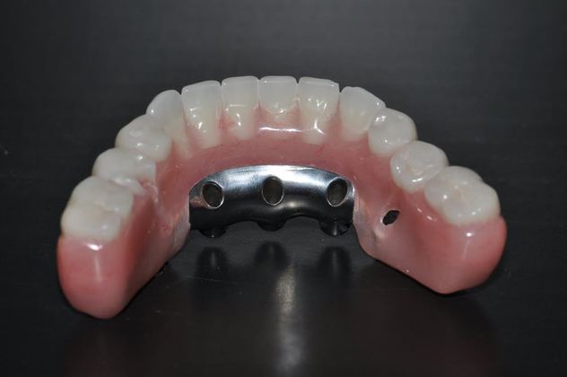 Full Mouth Restoration: Full Mouth Restoration