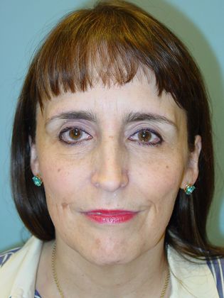 Facial Rejuvenation Case 1 - Before