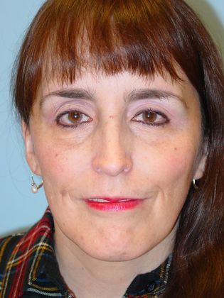 Facial Rejuvenation Case 1 - After