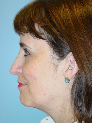 Facial Rejuvenation: Case 1 - Before