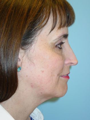 Facial Rejuvenation: Case 1 - Before