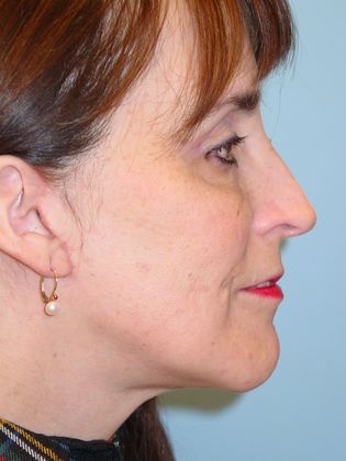 Facial Rejuvenation: Case 1 - After