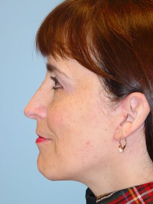 Facial Rejuvenation: Case 1 - After