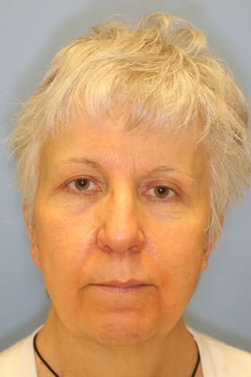 Facial Rejuvenation Case 2 - Before