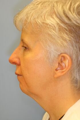 Facial Rejuvenation: Case 2 - Before