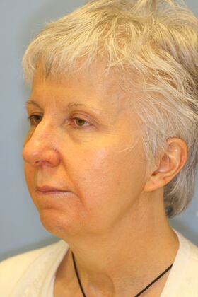 Facial Rejuvenation: Case 2 - Before