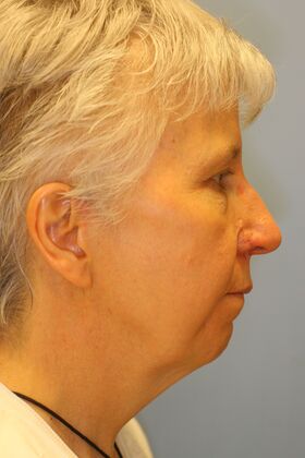 Facial Rejuvenation: Case 2 - Before