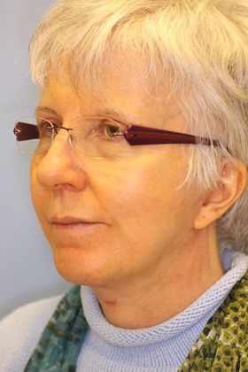 Facial Rejuvenation: Case 2 - After