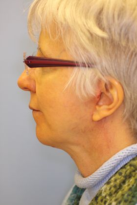 Facial Rejuvenation: Case 2 - After