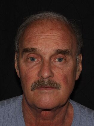 Facial Rejuvenation Case 3 - Before