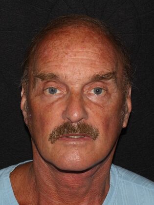 Facial Rejuvenation Case 3 - After