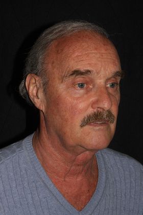 Facial Rejuvenation: Case 3 - Before