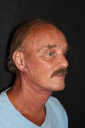 Facial Rejuvenation: Case 3 - After