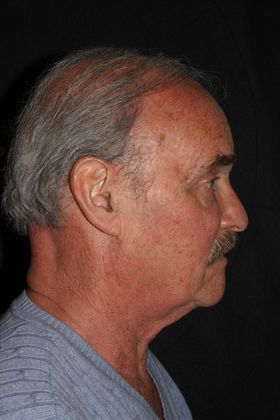 Facial Rejuvenation: Case 3 - Before