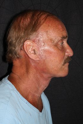 Facial Rejuvenation: Case 3 - After