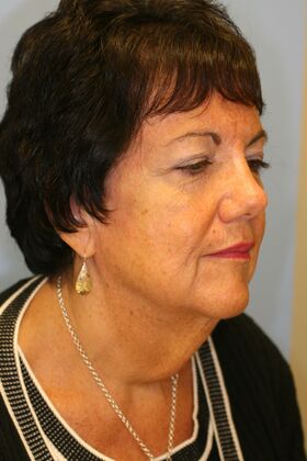 Facial Rejuvenation: Case 4 - Before