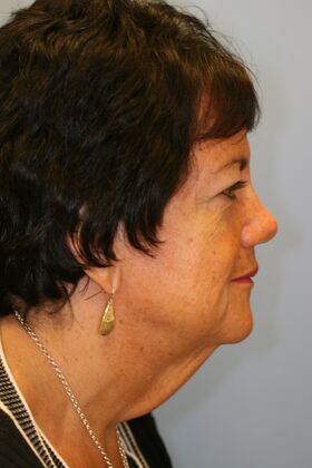 Facial Rejuvenation: Case 4 - Before