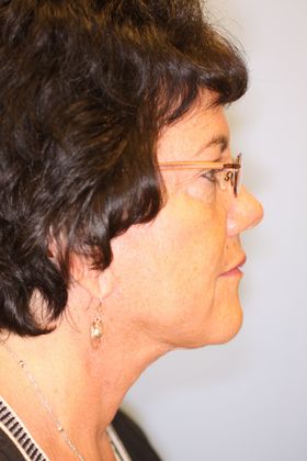 Facial Rejuvenation: Case 4 - After