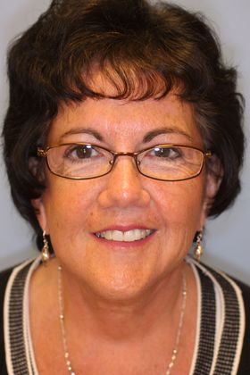 Facial Rejuvenation Case 4 - After