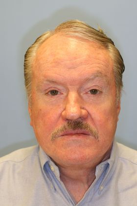 Facial Rejuvenation Case 5 - After