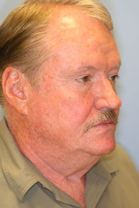 Facial Rejuvenation: Case 5 - Before