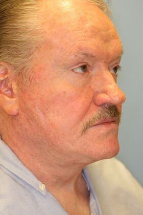 Facial Rejuvenation: Case 5 - After