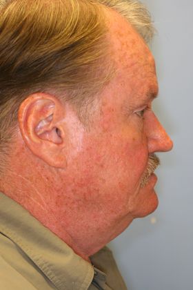 Facial Rejuvenation: Case 5 - Before